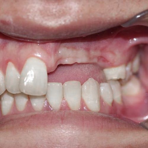 Hệ quả của việc mất răng lâu ngày